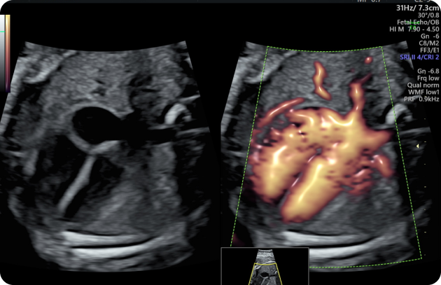 Fetal Echocardiography Ultrasound